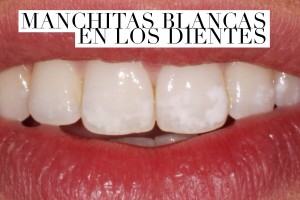 manchitas_blancas_en_los_dientes