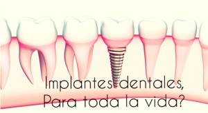 <alt>implante_dental