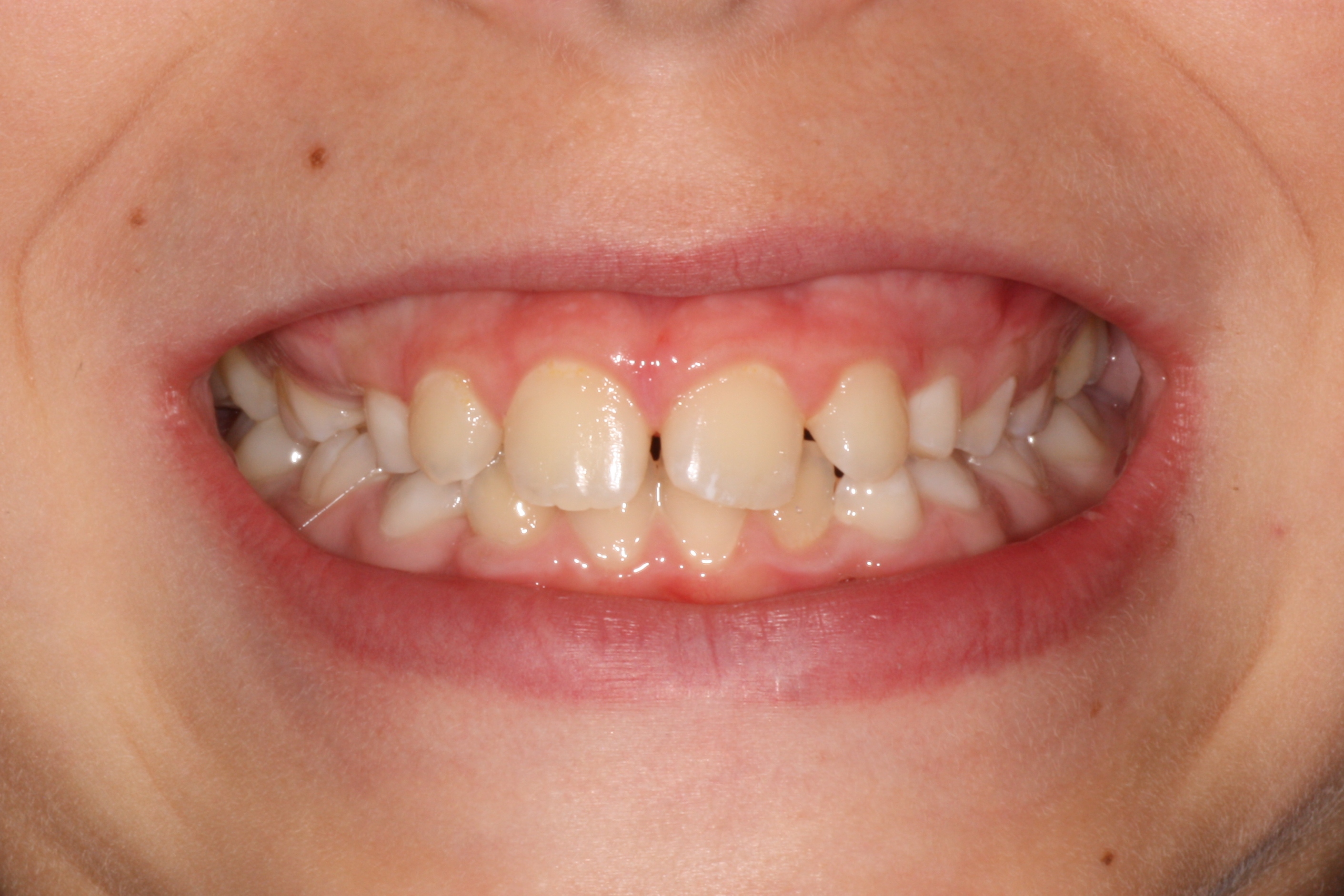 Color Dientes Leche Y Definitivos