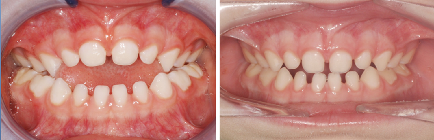 ortodoncia y chupete madrid