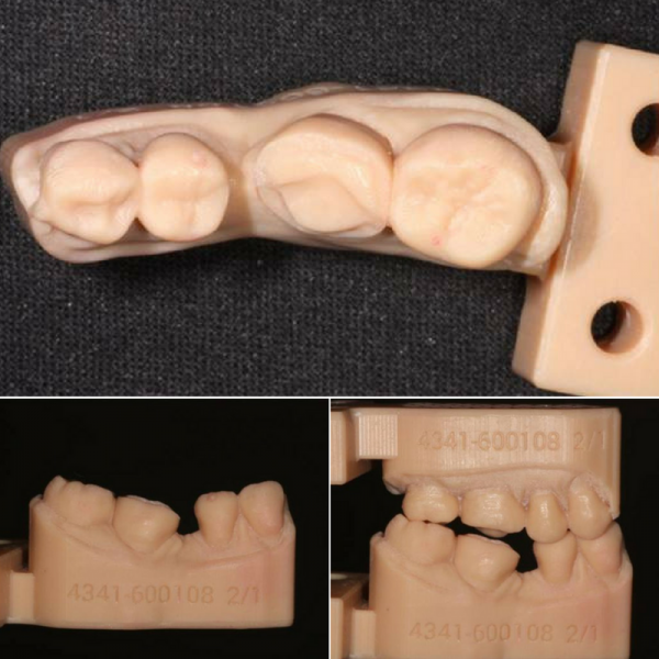 incrustacion dental clinica ortodoncia madrid