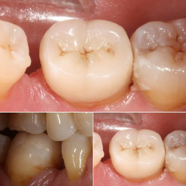 resultado incrustacion dental madrid