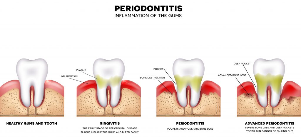 periodontitis e implantes dentales