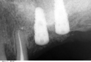 Tapon Cierre Implante Dental