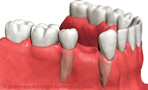 protesis asuencia del diente