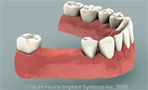 protesis asuencia de dos dientes