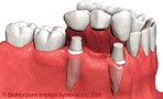 protesis puente sobre dientes
