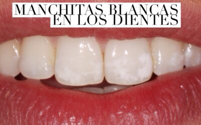 Manchas blancas en los dientes, ¿qué son?
