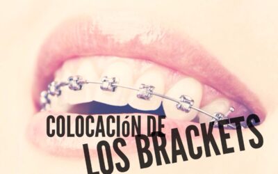 Cementado indirecto de brackets