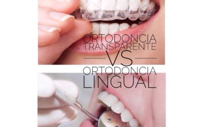¿Qué es mejor para mi, la ortodoncia invisible (Invisalign) o la ortodoncia lingual?