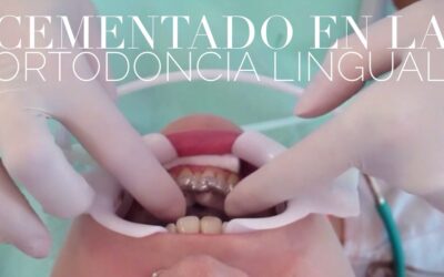El cementado indirecto en la ortodoncia lingual