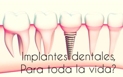 Implante dental ¿para toda la vida?
