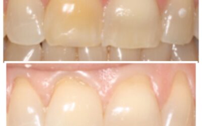 Tengo un diente negro, ¿qué puedo hacer?