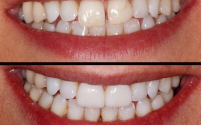 Espacio entre dientes: carillas de composite