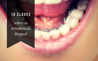 10 claves sobre la ortodoncia lingual