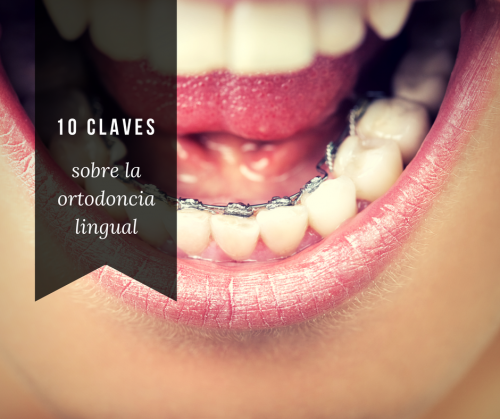 10 claves sobre la ortodoncia lingual