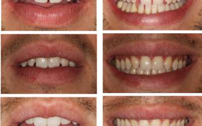 Tratamiento Multidisciplinar: Ortodoncia + carillas dentales