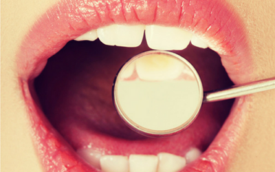 ¿Qué tengo que saber sobre la limpieza dental?