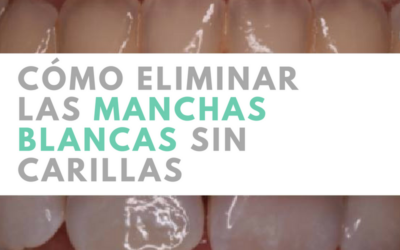 ¿Se pueden quitar las manchas blancas de mis dientes sin necesidad de carillas dentales?