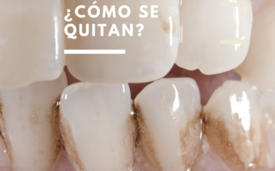 Manchas marrones en los dientes: ¿Se quitan fácilmente?