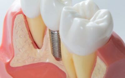 Preguntas frecuentes sobre los implantes dentales