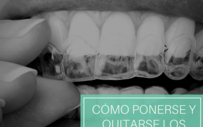 Alineadores transparentes Invisalign: cómo ponerlos y quitarlos