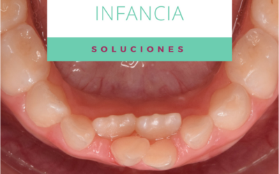 Dientes permanentes que salen por detrás de los dientes de leche: ¿qué hacemos?