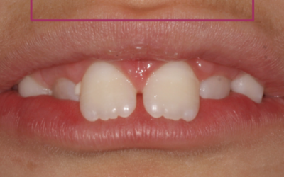 Hábitos en la boca de los niños: detección precoz