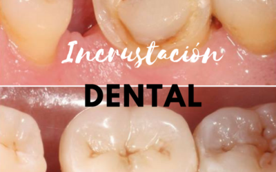 Incrustación dental: caso de una preparación digital