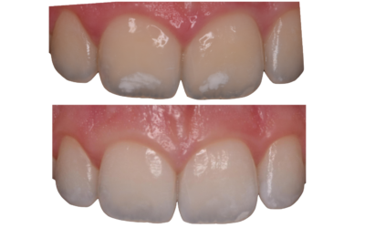 Manchas blancas en los dientes