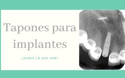 ¿Sabes lo que son los “tapones” de los implantes?
