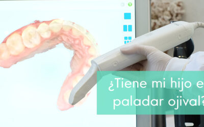 ¿Es la ortodoncia la solución para el paladar ojival?