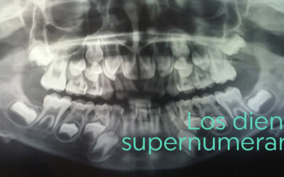 Dientes supernumerarios: ¿qué son?