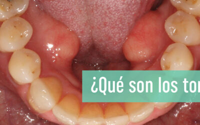 ¿Qué son los torus? ¿Cómo reconocerlos?