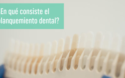 ¿En qué consiste un blanqueamiento dental?