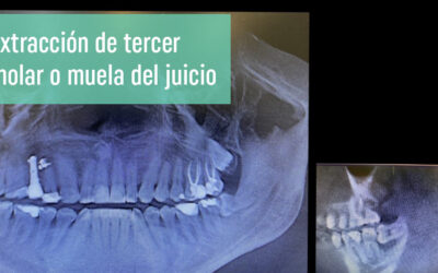 Extracción tercer molar o muela del juicio