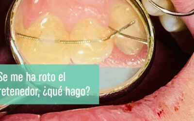 ¿Cómo arreglar un retenedor roto?