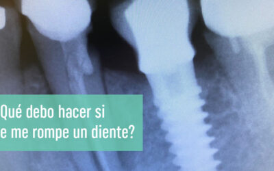 ¿Qué debo hacer si se me rompe un diente?