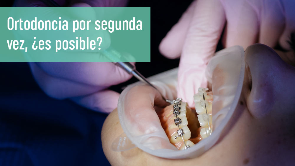 Ortodoncia por segunda vez: ¿es posible retomar este tratamiento?