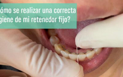 ¿Cómo se realiza una correcta higiene de mi retenedor fijo?
