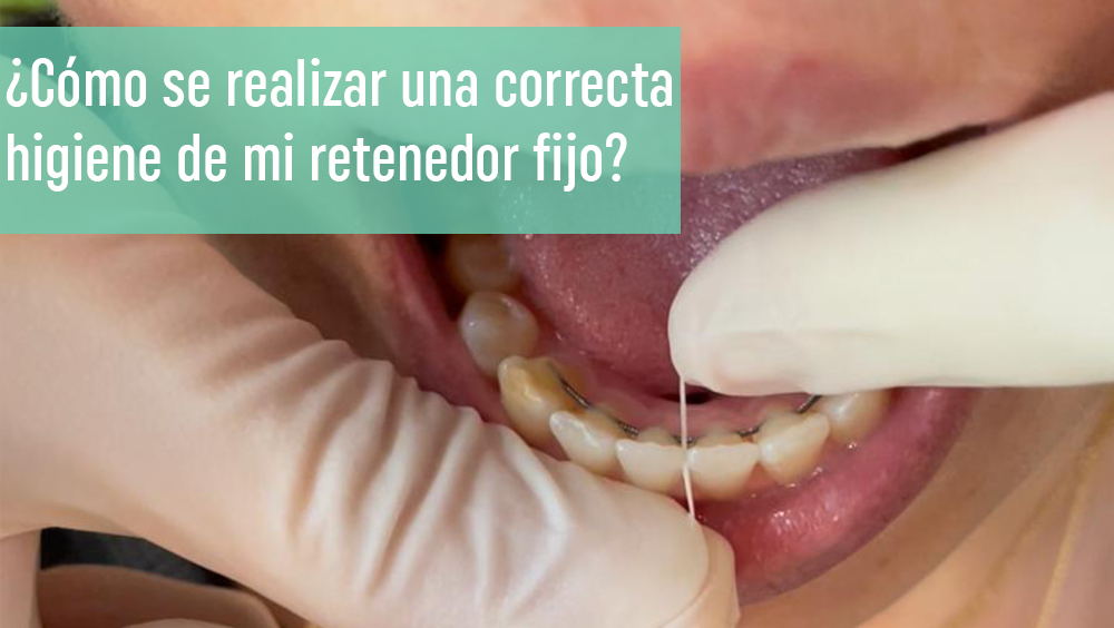 como-realizar-limpieza-retenedor-fijo