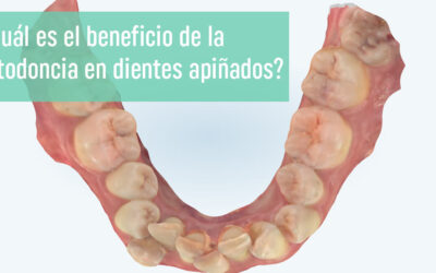 ¿Cuál es el beneficio de la ortodoncia en dientes apiñados?