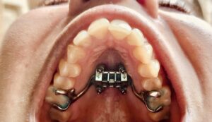 Expansión maxilar superior