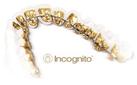 incognito-lingual