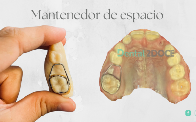 Mantenedor de espacio dental en niños: ¿Por qué es importante y qué ocurre si no se coloca?