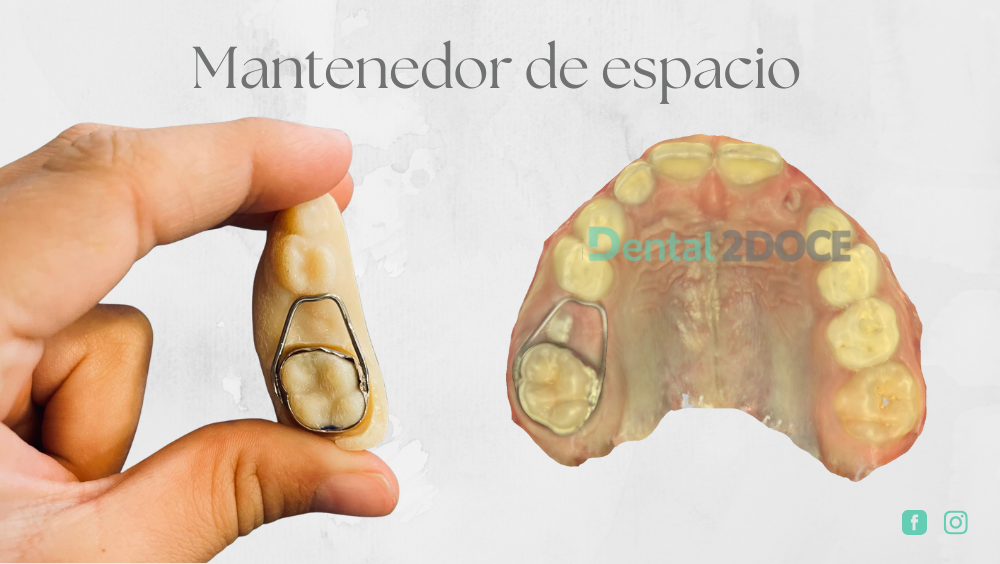 Un mantenedor de espacio dental para niños.