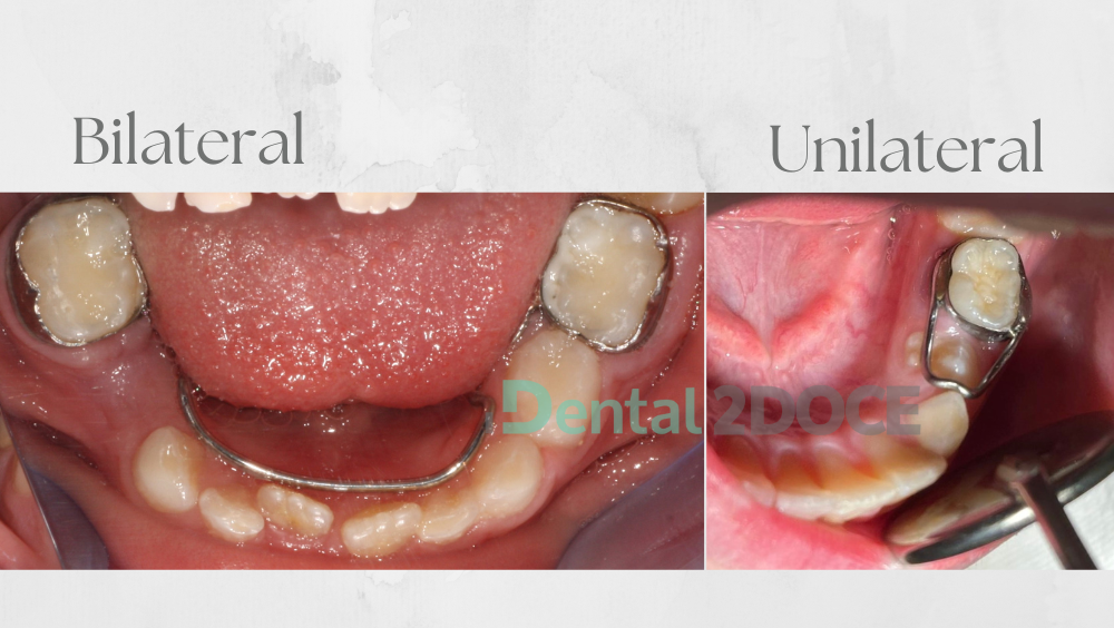 Imagen de un caso en el que se colocó un mantenedor de espacio.