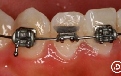 Bracket despegado en ortodoncia: qué hacer y cuándo acudir a la clínica