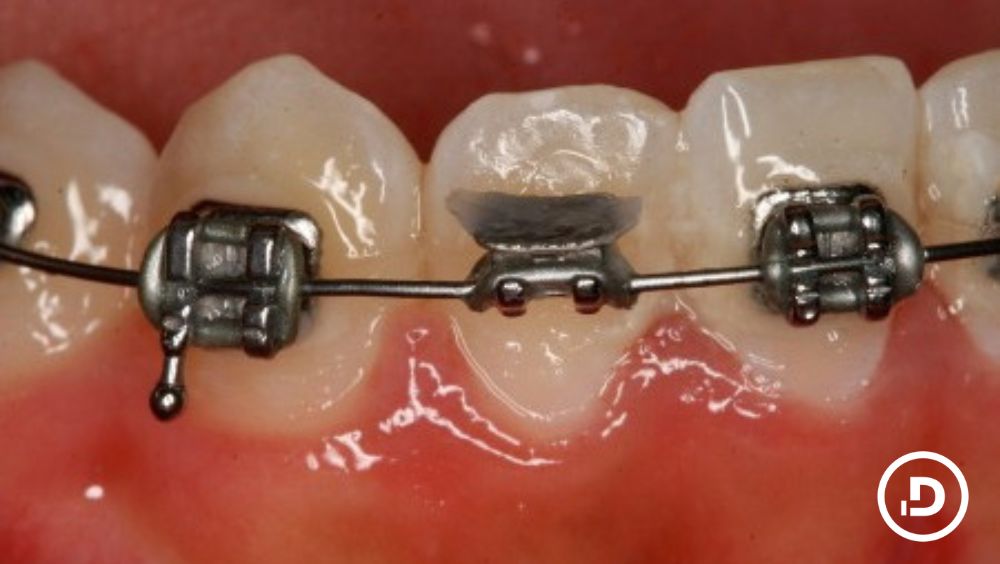 Un bracket despegado en un paciente de ortodoncia.