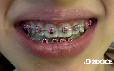 Urgencias con brackets: guía práctica para pacientes de ortodoncia